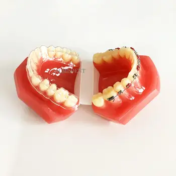  2piese de Înaltă Calitate Dentare Model de Studiu Invizibil de Fixare Paranteze de Metal Contrast Aligner Comparație